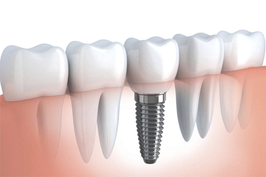 6 Tips to Care for Dental Implants Immediately after Surgery