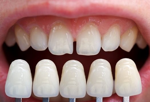 Cosmetic Dental Veneers – Facts You Must Know