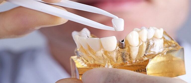 How Do Dental Implants Work With Your Existing Teeth?