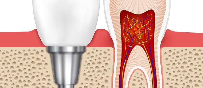 5 Important Things to know about Dental Implants