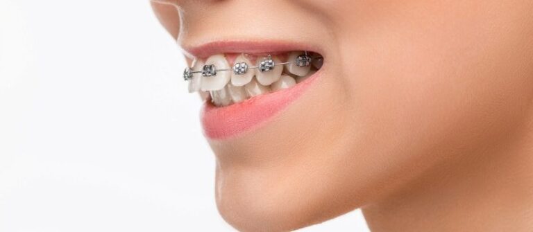 7 Dental Care Tips for People with Braces
