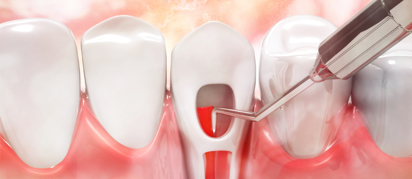 Why Choose Root Canal Treatment Over Other Alternatives?