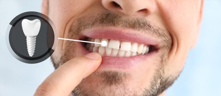 Smile Restoration: Rediscovering Confidence with Dental Implants