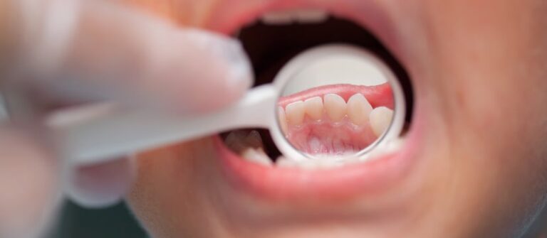 Beyond Cleaning: Understanding Preventive Dentistry and Its Benefits