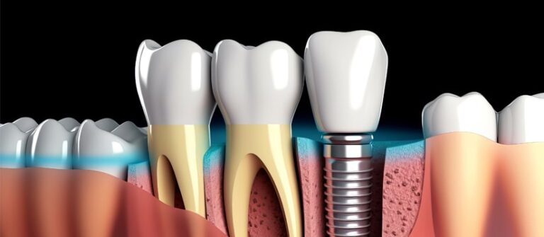 Dental Implants in Karachi: A Permanent Solution for Missing Teeth