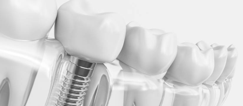 10 Tips for Long-Lasting Dental Implants